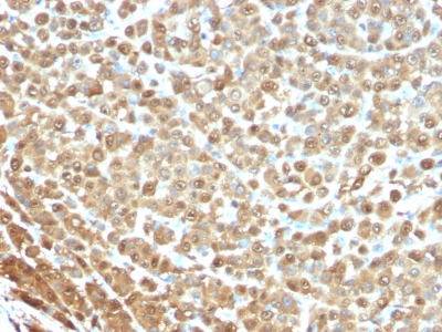 FFPE human melanoma sections stained with 100 ul anti-S100A1 (clone 4C4.9) at 1:200. HIER epitope retrieval prior to staining was performed in 10mM Citrate, pH 6.0.